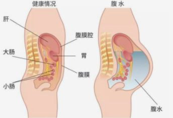 取完卵哪些症状可以看出有腹水？