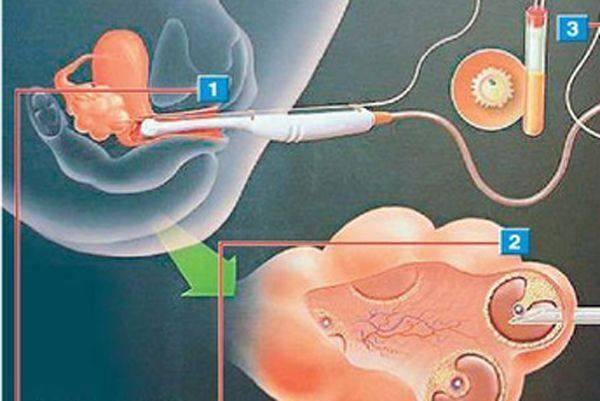 那么取卵手术进程是怎样的呢?